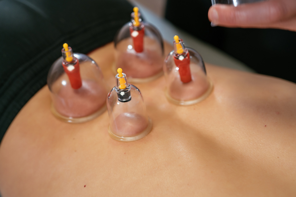 Four transparent suction cups attached to a patient's back.