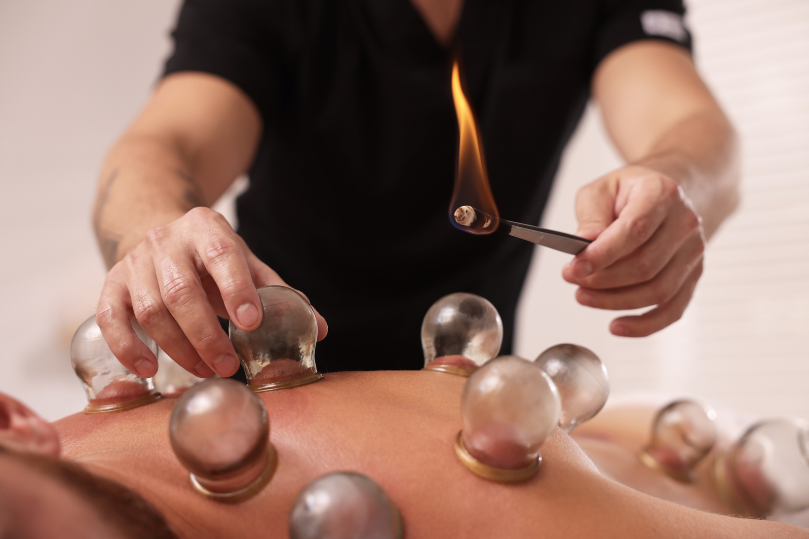 Therapist Giving Fire Cupping Treatment to Patient Indoors, Clos